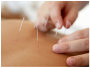 acupuncture